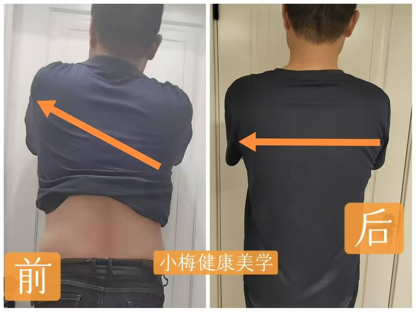 李先生体态调整高低肩前后对比图