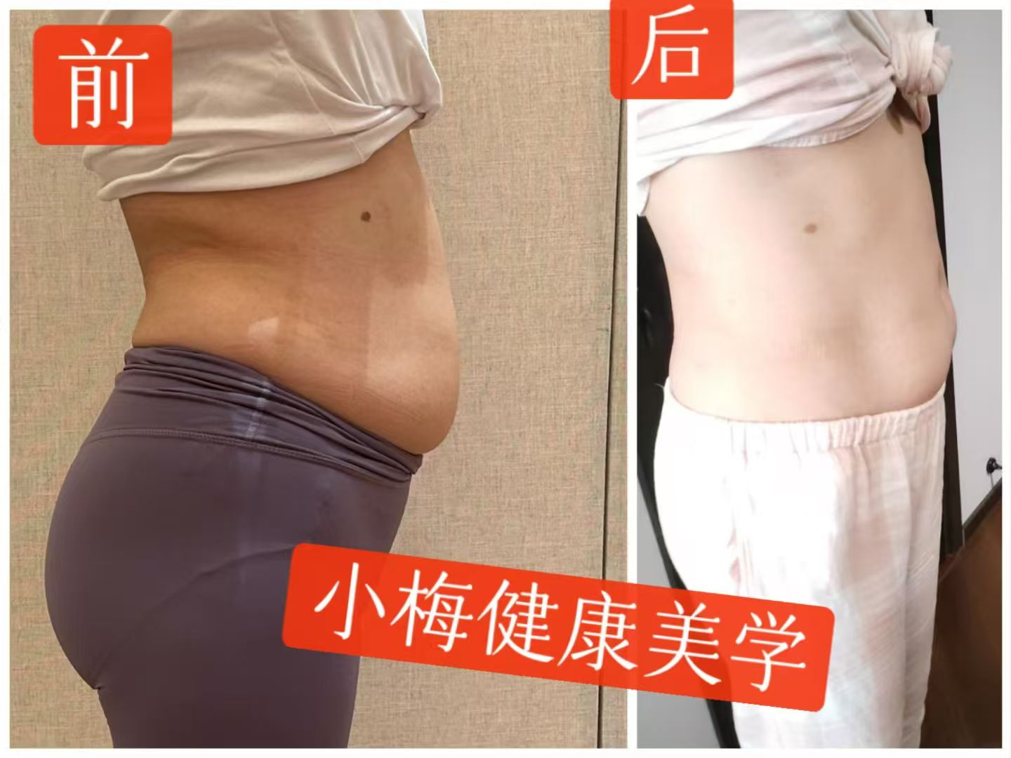 张女士骨盆前倾大肚子调理前后对比图