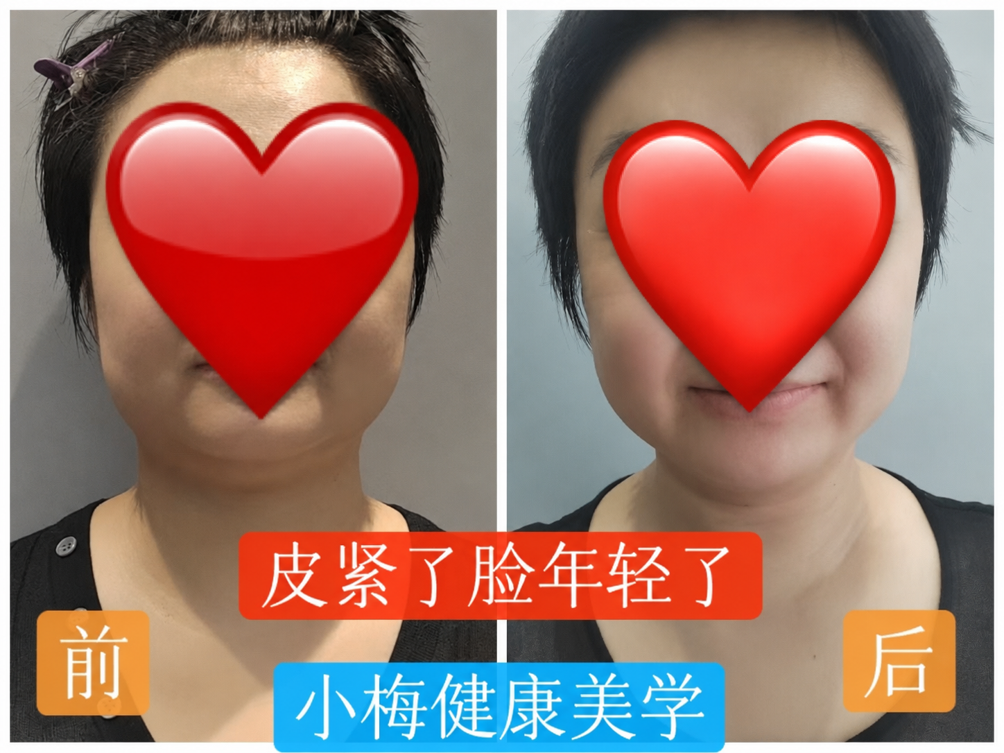 陆女士脸部紧致调理前后对比图